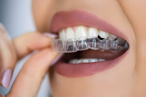 confident smile this womens day with clear aligners