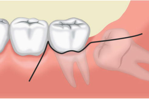 Flap Surgery