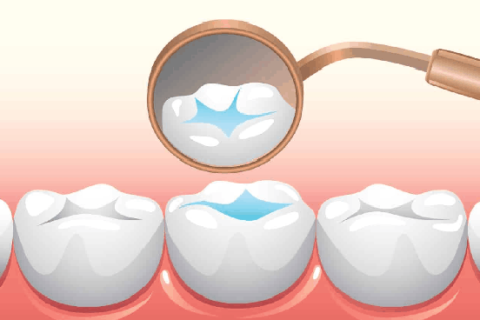 Pit and Fissure Sealants