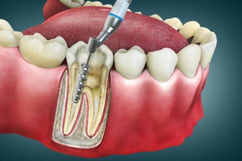 Root Canal Treatment