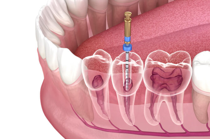 Root Canal Treatment (RCT): A Complete Guide to Save Your Natural Teeth By Dr Haritha Tooth Align