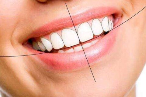 Smile Design