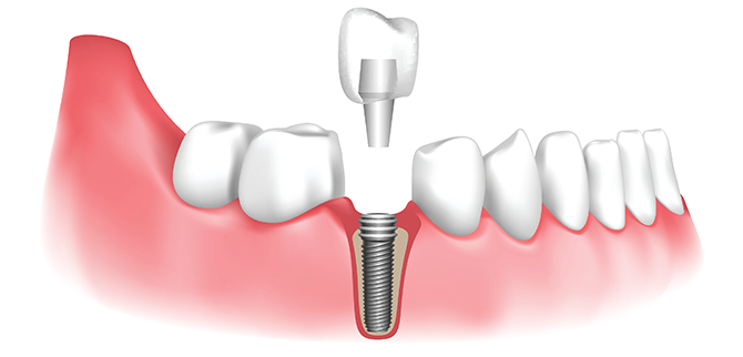 All-on-Four Implants: A Complete Guide to Restoring Your Smile By Dr Haritha Tooth Align