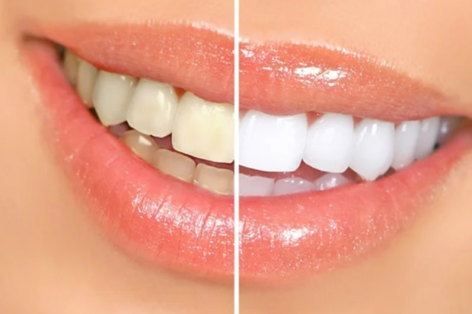 Teeth Whitening: A Brighter Smile