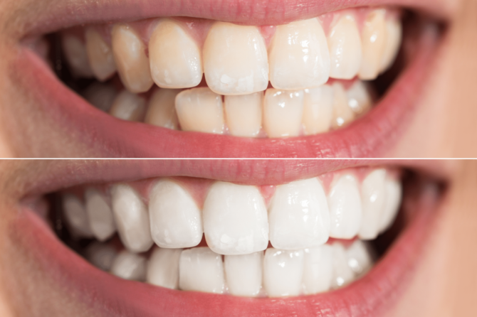 Best Teeth Whitening in HSR Layout – Get a Brighter Smile Today!
