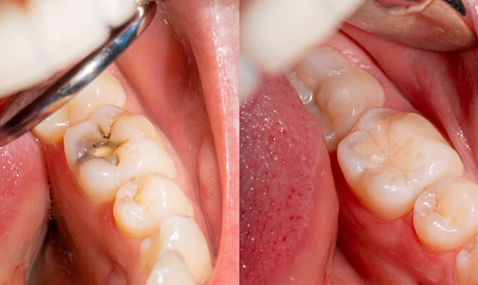 Tooth-Colored Restoration: A Guide to Natural-Looking Dental Solutions By Dr Haritha Tooth Align